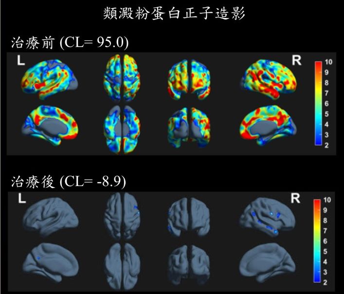 早期治療正向示範 土城醫院公布失智症新藥追蹤成果 8 《圖說》曾敬仁主任指出類澱粉蛋白正子造影檢查顯示,患者治療前(上圖)腦中異常蛋白負荷顯著增加,治療六個月後(下圖)降至正常範圍,反映治療帶來的明顯成效。〈土城醫院提供〉