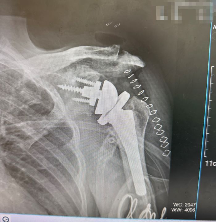 《圖說》反式人工肩關節手術,改善長期肩關節退化合併旋轉肌嚴重破裂。〈臺北醫院提供〉